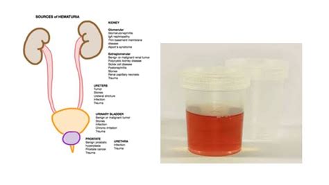 Treatment For Blood In Urine Urology Hospital In Chennai Dr Rela