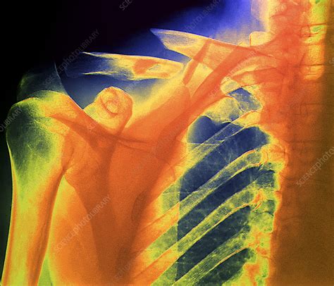 Fractured Collar Bone X Ray Stock Image M3301357 Science Photo