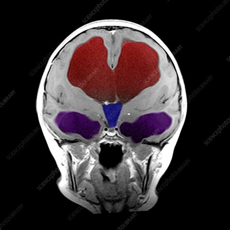 Hydrocephalus Of Third Ventricle Stock Image C0034642 Science