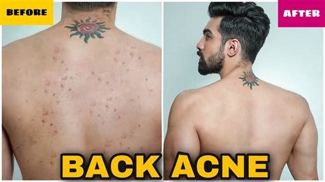 HOW TO REMOVE BACK ACNE FAST MEN WOMEN NATURAL PIMPLES BACK ACNE