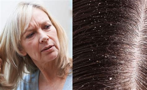 Apakah pertumbuhan rambut yang normal? Botak Dan Gugur Rambut? Kenali Punca Masalah Rambut