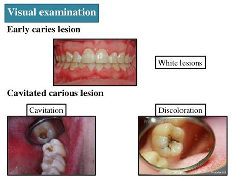 Preventive Dentistry And Early Caries Detection