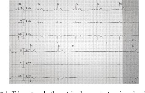 Figure From Symptomatic Long Pauses And Bradycardia Due To Massive