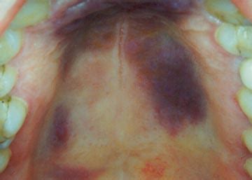 H Rozsypal Orogastrointestinální infekce dutina ústní