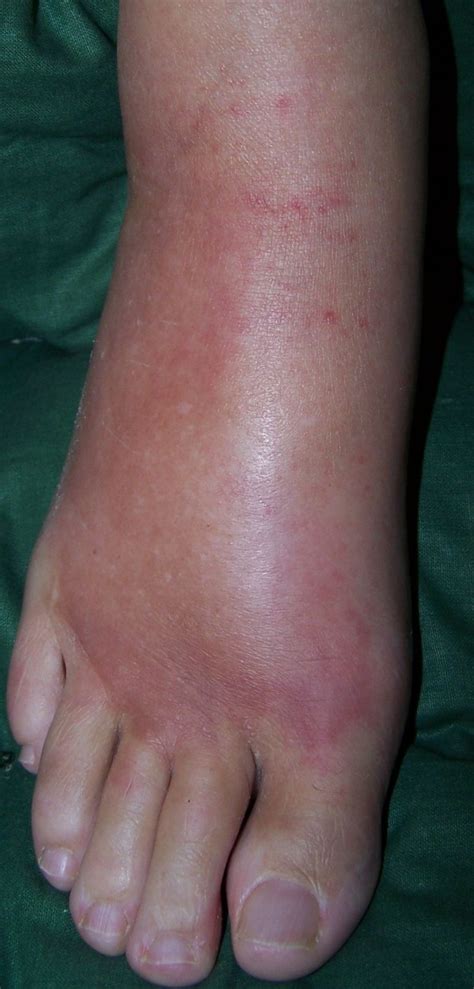 Swollen Red Sore Spots On Feet