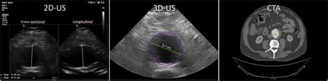 Three Dimensional Ultrasound Improves Identification Of Patients With