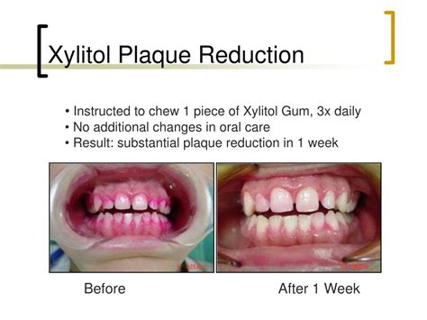 PPT The Health Benefits Of Xylitol PowerPoint Presentation Free