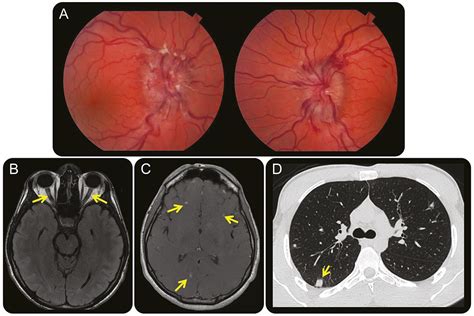 Clinical Reasoning A 22 Year Old Man With Diplopia Neurology