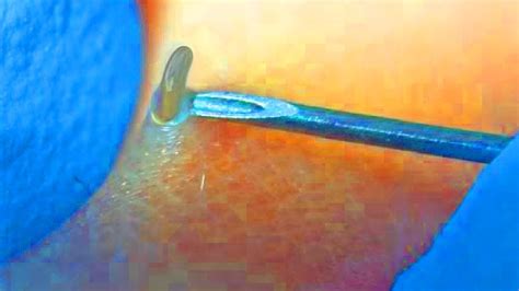 Recurrent cases are sometimes called folliculitis. What Does Ingrown Hair Look Like? - YouTube