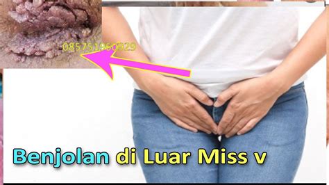 Ilustrasi wanita menutupi miss v. Benjolan di Luar Miss v - Obat Kutil Kelamin Herbal - YouTube