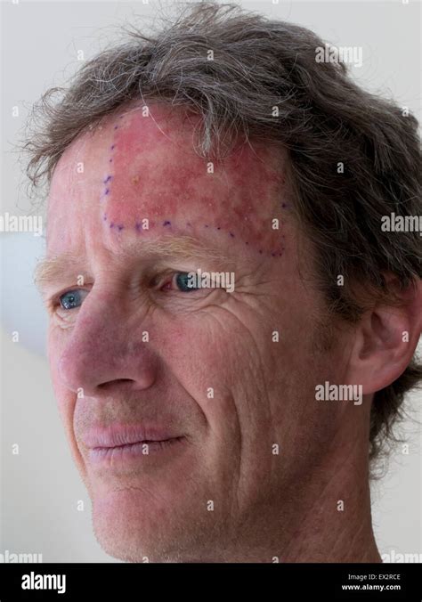 Man Sun Damage Treatment Stock Photo Royalty Free Image 84884814 Alamy