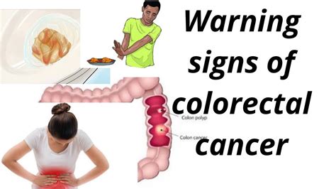 Warning Signs Of Colorectal Cancer Youtube