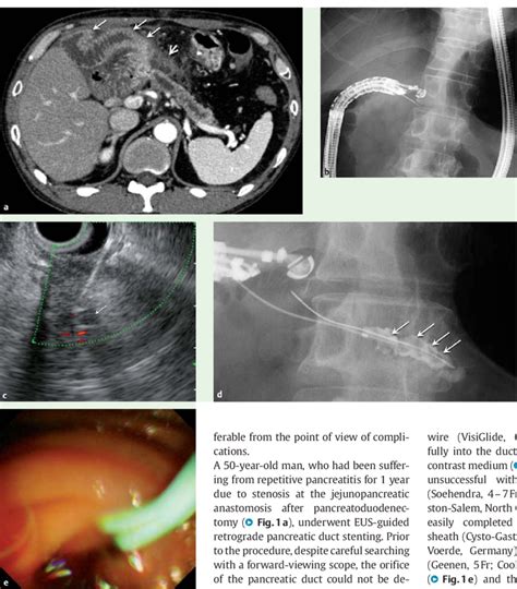 A E Images Of The Pancreatitis And The Initial Procedure A Computed