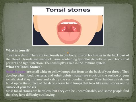 Ppt Tonsil Stones And Treatment Ent Treatment In Gurgaon Powerpoint