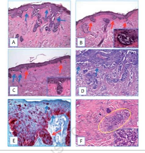 Figure 1 From Clinical Dermoscopic And Histological Features Of A