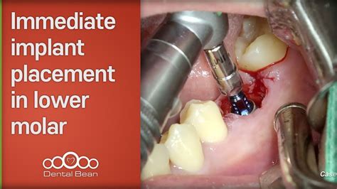 Immediate Implant Placement In Lower Molar Dr Kim Yongjin Youtube