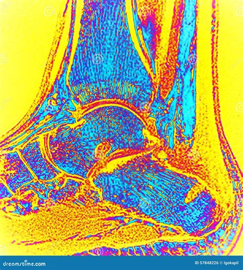Right Ankle after Surgery Haglund Deformity Mri Stock Photo - Image of