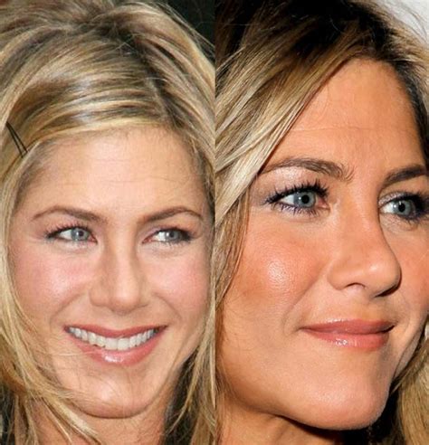 Jennifer Aniston Plastic Surgery Before And After Photos Plastic Surgery Before And After