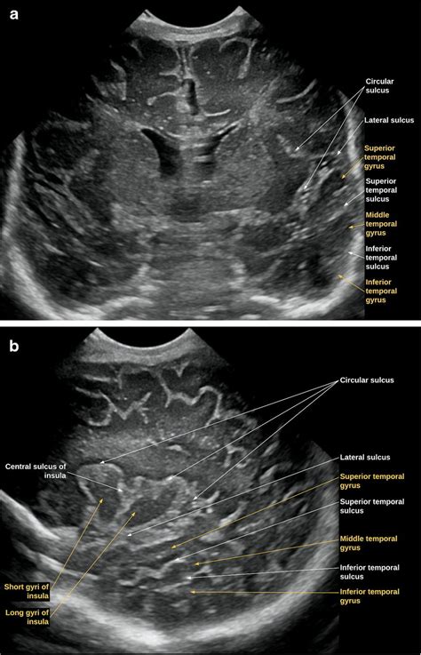 Neurosonography Images Of A 3 Day Old Boy In The Coronal Plane A And