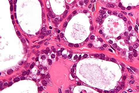 Clear Cell Carcinoma Of The Ovary Libre Pathology