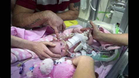 Graphic Video Baby Born With Heart Outside Her Body Now 3 Weeks Old