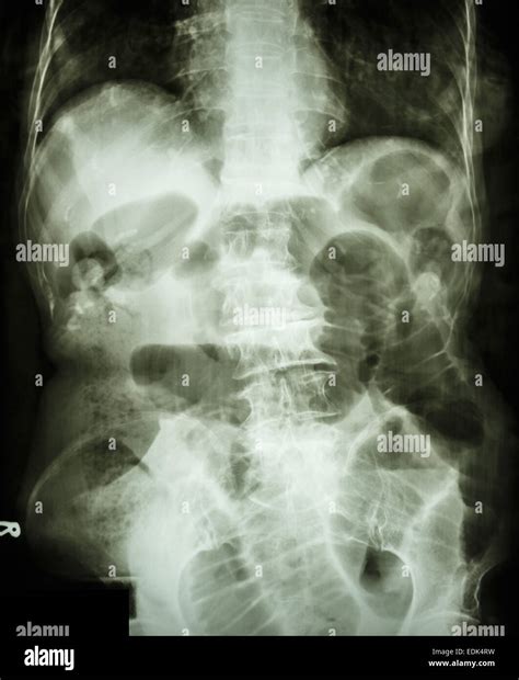 Film X Ray Abdomen Supine Show Small Bowel Dilated And Air In Small