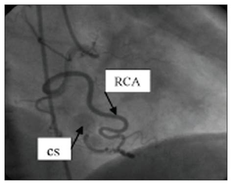 Coronary artery bypass surgery — heart bypass redirects here. A case of angina pectoris with concomitant fistulization of the diagonal and right coronary ...