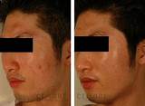 Is Laser Treatment Good For Acne Pictures