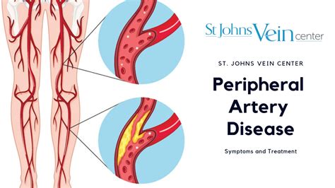 Peripheral Artery Disease Pad St Johns Vein Center