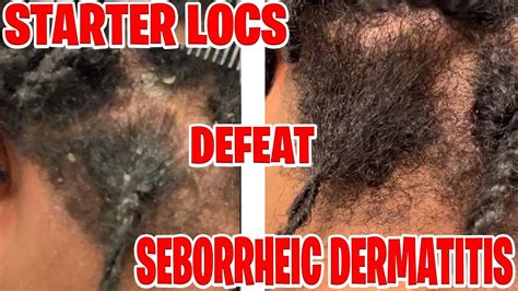 How I Defeatedtreated Seborrheic Dermatitis Managing With Starter Locs