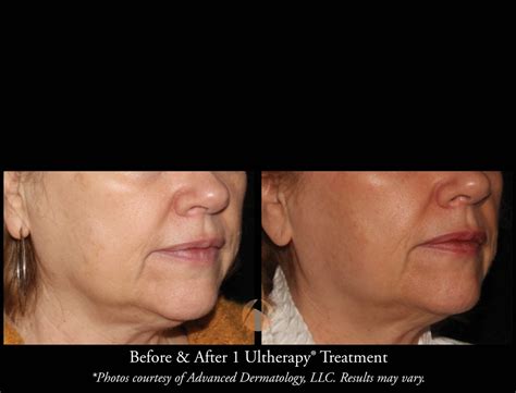 Lower Face Aging Treatment For Double Chins Chicago Il Advanced