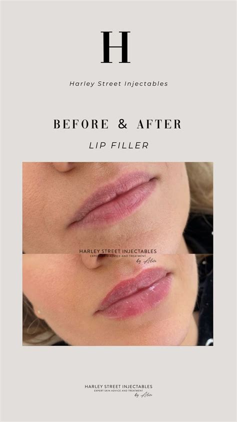 Subtle Lip Fillers Can Completely Transform Your Face And Give Your