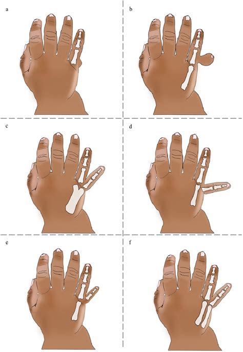 Figure From To Tie Or Not To Tie A Systematic Review Of Postaxial Polydactyly And Outcomes Of