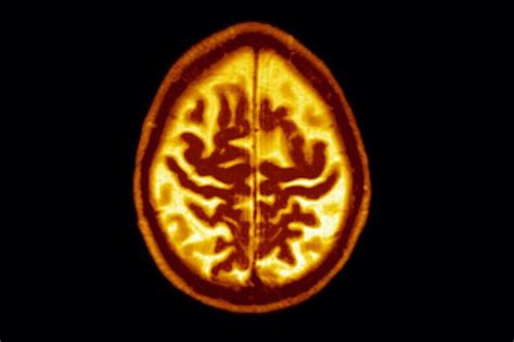 The same problems generally occur, but the disease can have a different impact on a younger person because they are more likely to be employed full time, raising a family or financially responsible for a family. Alzheimer's vs dementia: How does age affect Alzheimer's ...