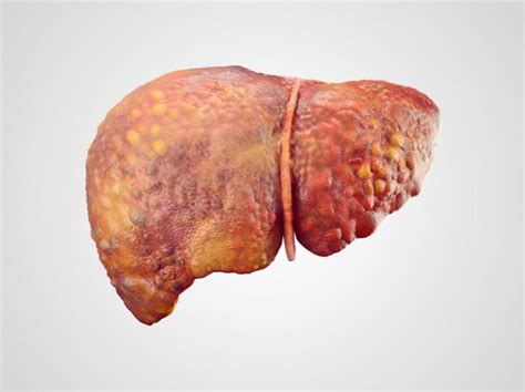 Webmd says some of them may surprise you. Not a alcoholic , still your liver can damage by these ...