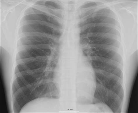 They are located in the chest, either side of the mediastinum. Chest - wikidoc