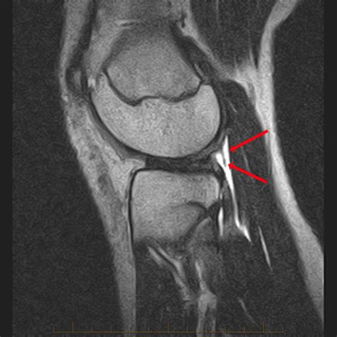 Arcuate Ligament Proscan Education