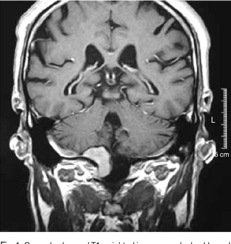 Figure 1 From Isolated Intracranial Rosai Dorfman Disease A Case