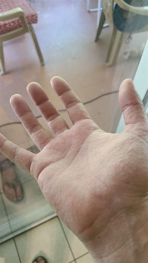 What Are These Bumps On My Hands 2nd Day Now Rdermatologyquestions