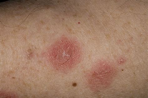 Nummular Eczema Causes Symptoms Treatment Pictures Healthmd