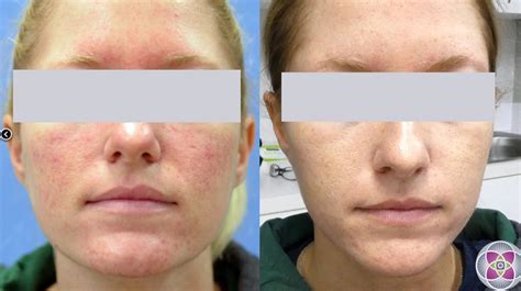 Laser Treatment For Rosacea Richmond Hill Cosmetic Clinic