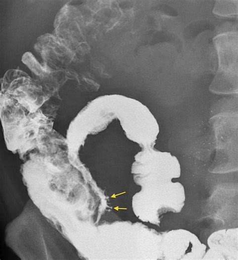 Crohn Disease Rosethorn Ulcers Radiology At St Vincents