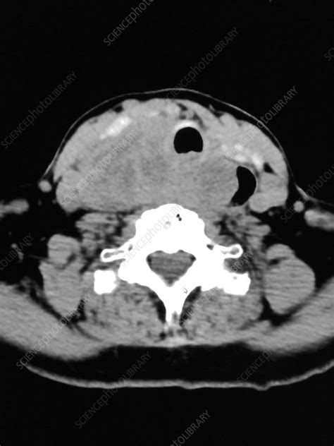 Anaplastic Carcinoma Of Thyroid Gland Ct Stock Image C0394043