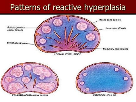 Slides Of Lymphoma And Metastasis