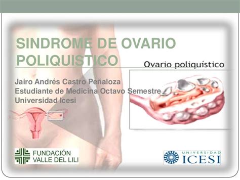 Síndrome De Ovario Poliquístico