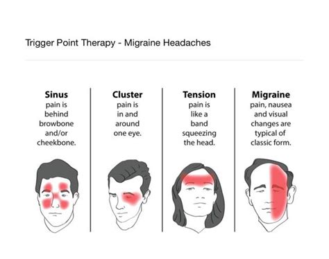 Trigger Point Therapy Migraine Headaches Tension Migraine Migraine