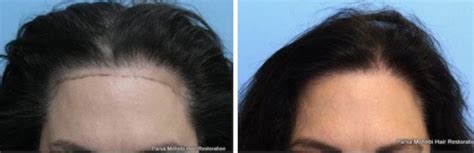 Hairline Lowering Facts Surgery Vs Hair Transplantation Gilmore