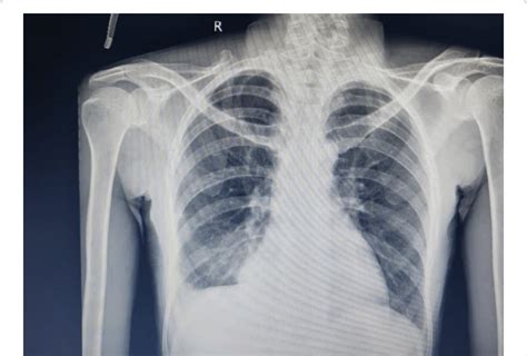 Chest Radiograph At Diagnosis Showing Blunting Of Right Costophrenic