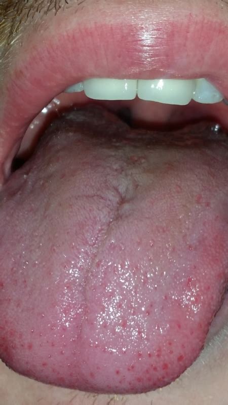 Red Spots On Tongue Is It Oral Thrush Fungal And Yeast Infections