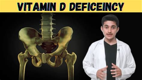 Osteomalacia 3d Animation Vitamin D Function Deficiency Cause